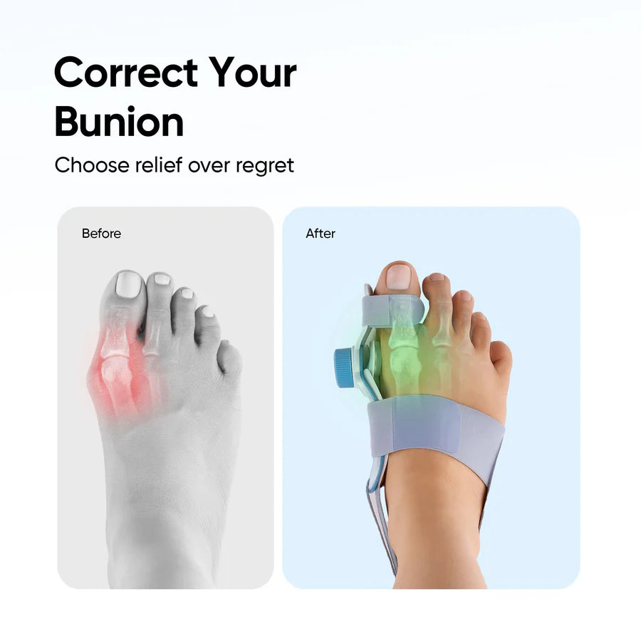 Zappnex Orthopedic Bunion Corrector